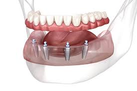 All-on-4 / All-on-6 — implant üstü sabit dişler